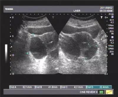 成都妇科专家谈卵巢囊肿会不会影响怀孕